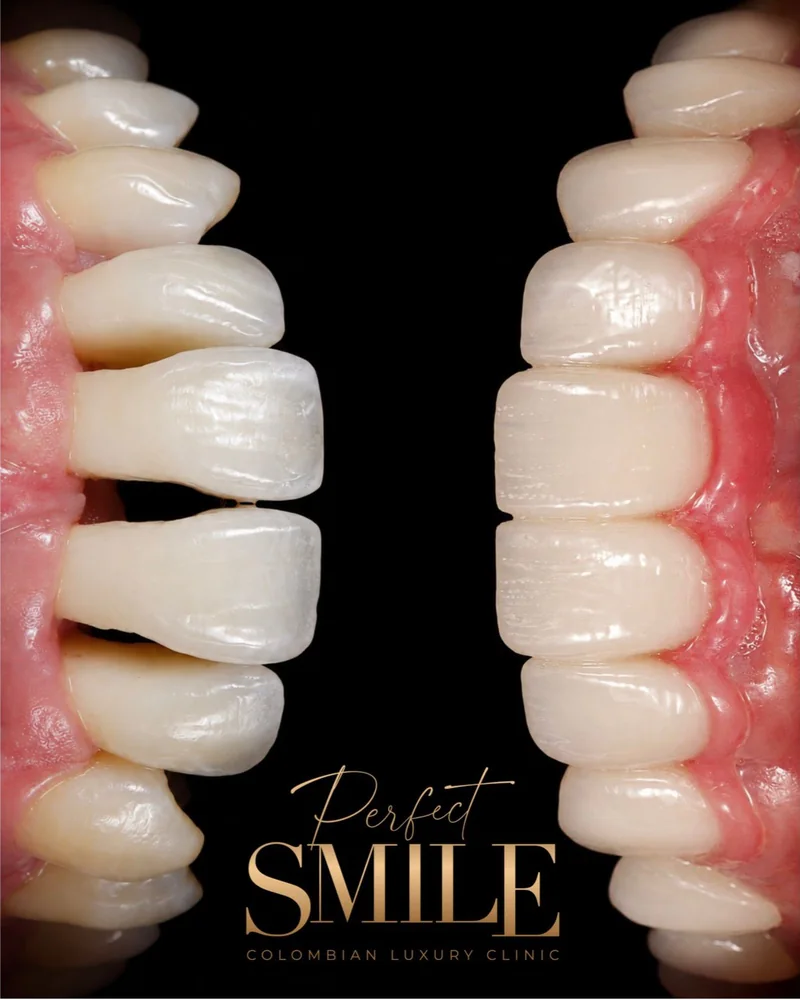 Detalle de carillas dentales antes y después en Perfect Smile