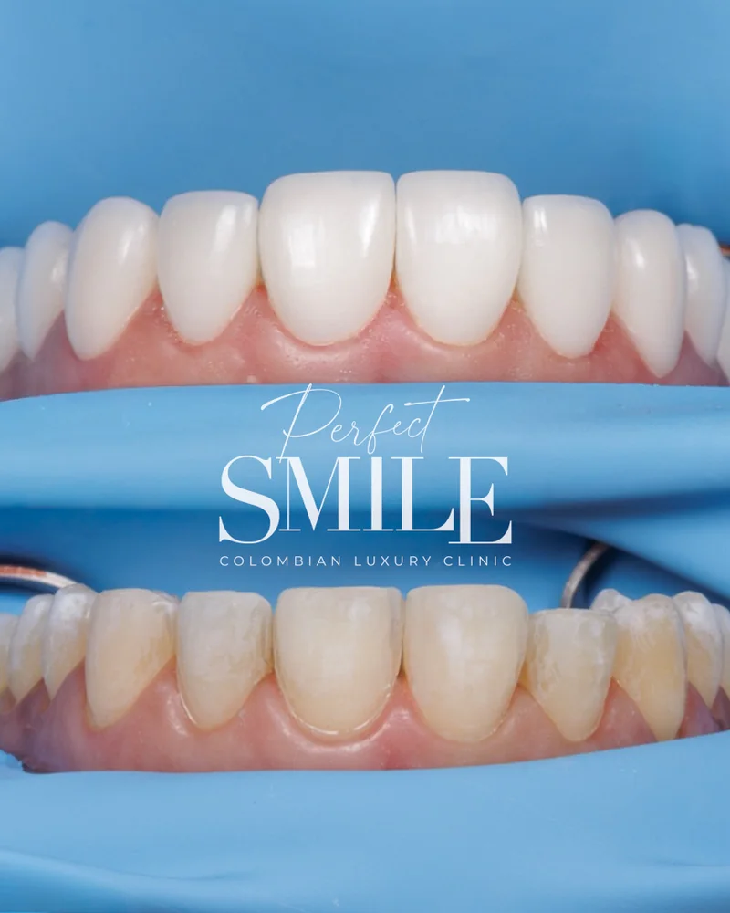 Comparación de tono dental antes y después del tratamiento en Perfect Smile